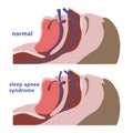 Sleep apnea. Respiratory tract diagram.